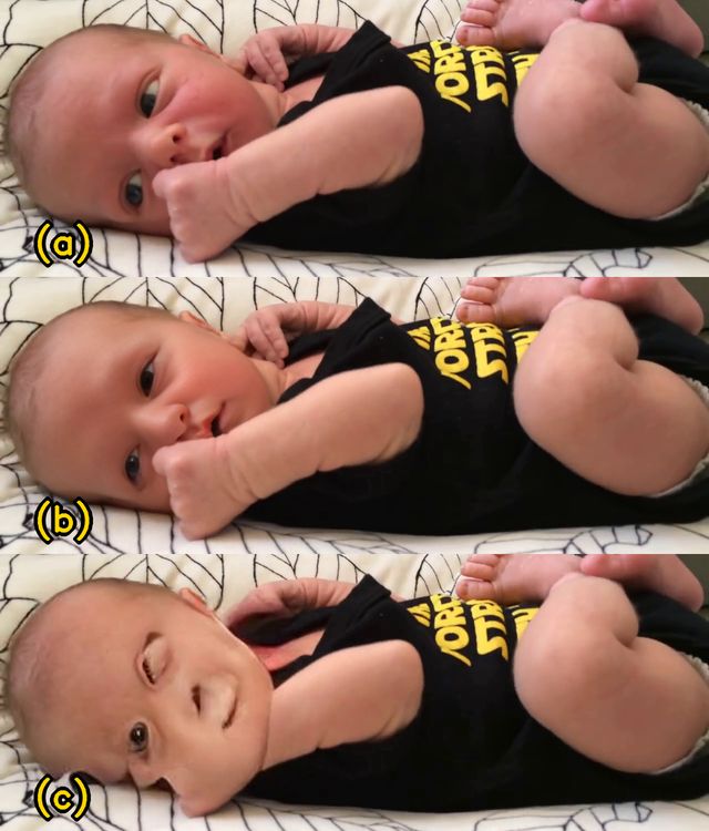 An infant's face anonymized with a compatible synthetic replacement, preserving expression and pose while removing the original identity.